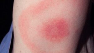 Bullseye rash from tick bite