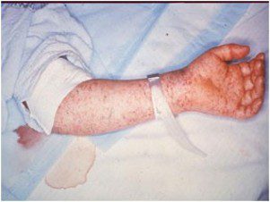 Rocky mountain spotted fever rash from tick bite